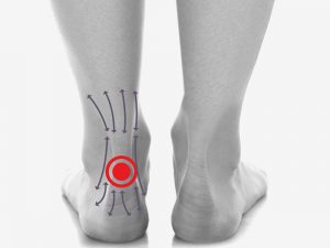 bol_sciegna_achillersa