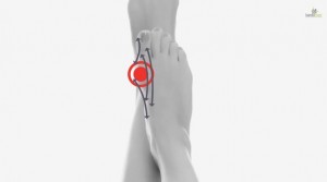 Hallux-leczenie-fala-uderzeniowa