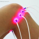 LASERNEEDLE_Foto_Gon#68471B