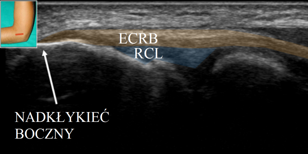 Przezskórna elektroliza epte
