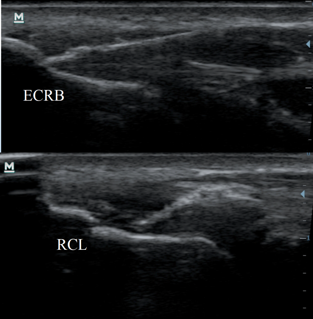 Przezskórna elektroliza Epte