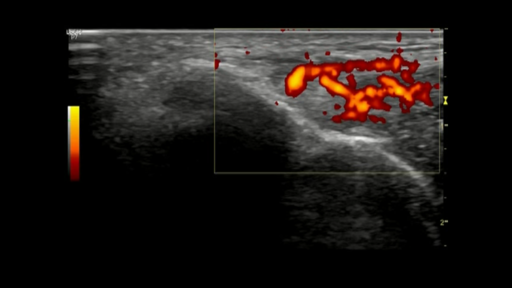 Przezskórna elektroliza Epte