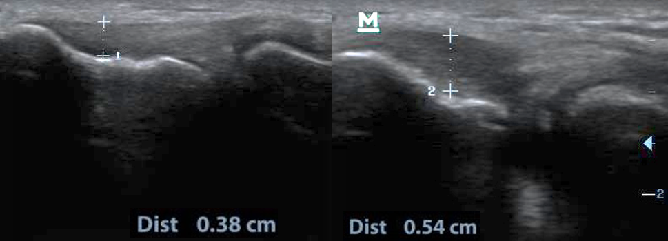Przezskórna elektroliza Epte