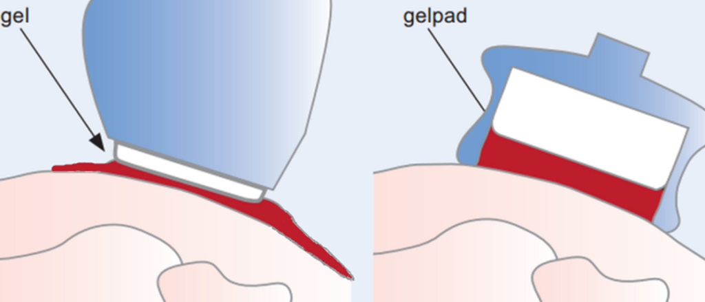głowica do aparatu do ultradźwięków status 190 s