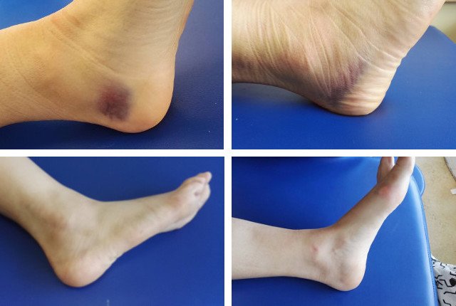 Leczenie skręconego stawu skokowego laserem iLUX - efekty