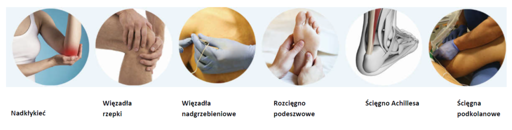 Tendinopatie - rodzaje schorzeń ścięgien
