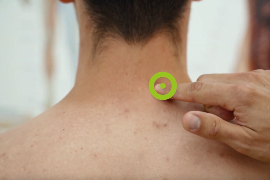  Leczenie bólu kręgosłupa szyjnego aparatem Doctor TECAR