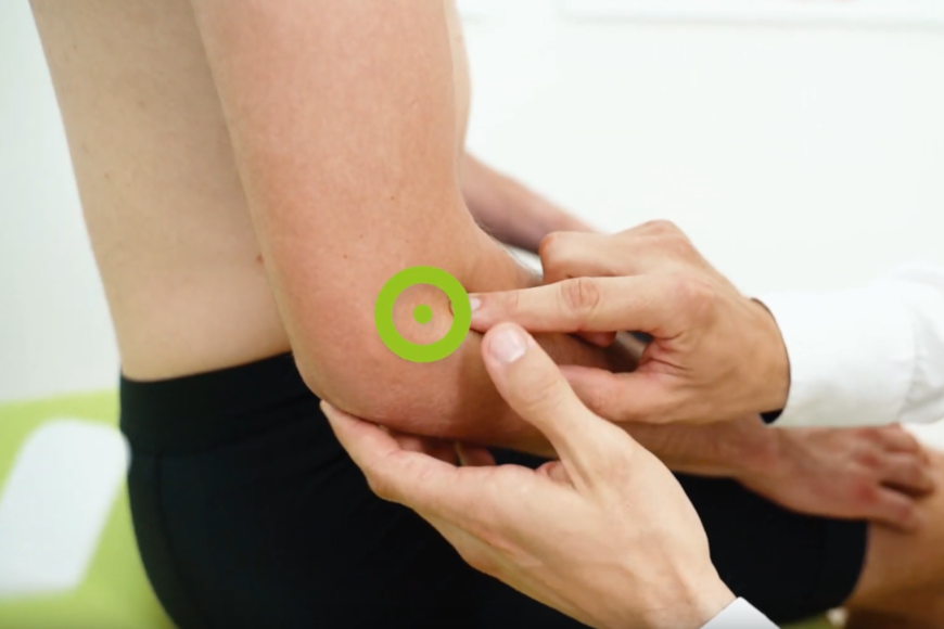 Leczenie łokcia tenisisty z wykorzystaniem terapii TECAR