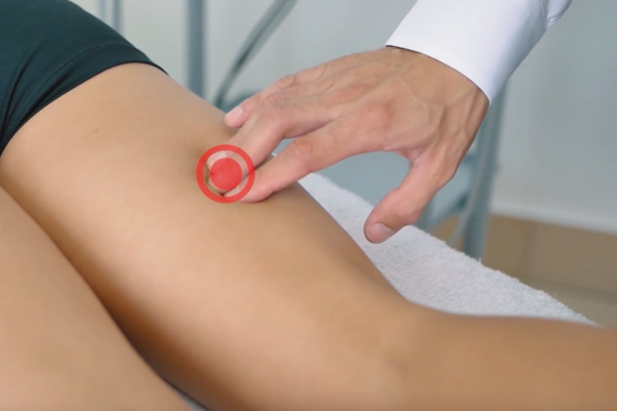 Terapia punktów spustowych