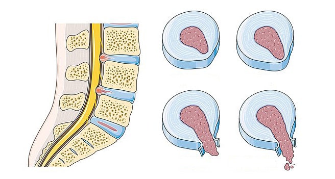 Przepuklina kręgosłupa i stopnie degeneracji krążków międzykręgowych