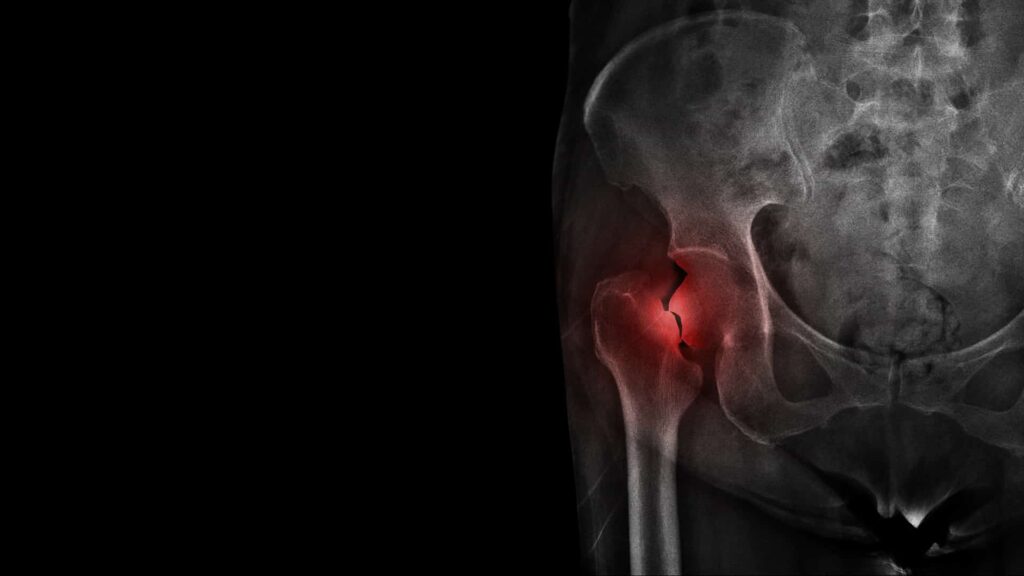 Kontuzja biodra: złamanie szyjki kości udowej widoczne na zdjęciu rentgenowskim