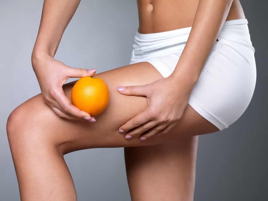 Stopnie cellulitu i skuteczne zabiegi na usuwanie “skórki pomarańczowej”
