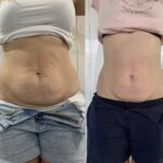 Wyszczuplanie i ujędrnianie brzucha terapią TECAR