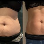 Efekty terapii TECAR – zabieg na brzuch