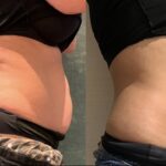 Wyszczuplanie brzucha terapią TECAR