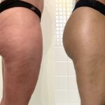 Redukcja cellulitu – efekty terapii TECAR