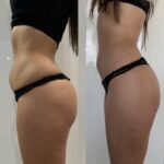 Modelowanie sylwetki zabiegiem TECAR