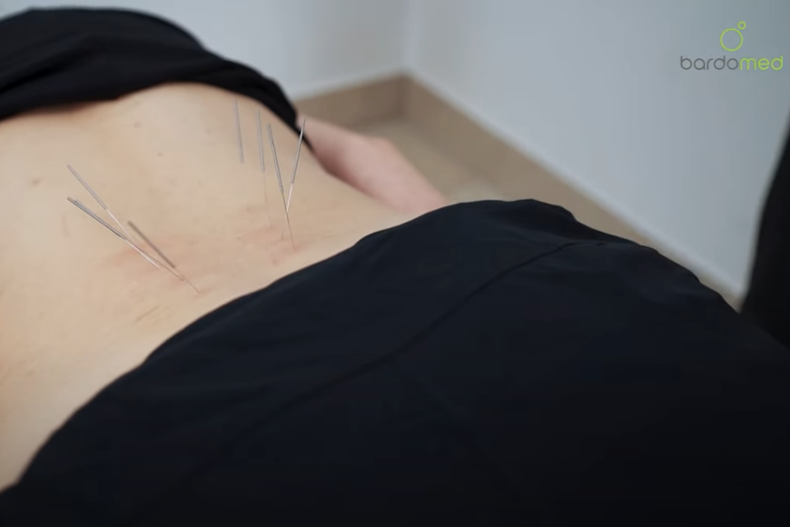 Zabieg suchego igłowania na kręgosłup lędźwiowy