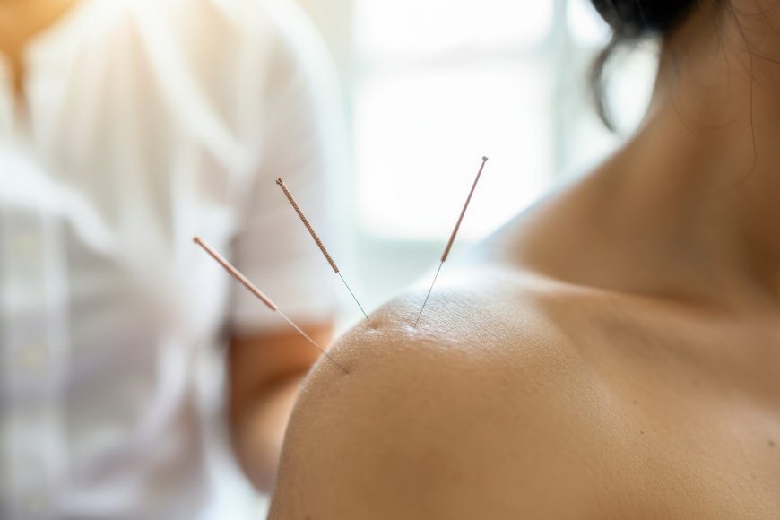 Igłoterapia – jej rodzaje i cele w postępowaniu fizjoterapeutycznym