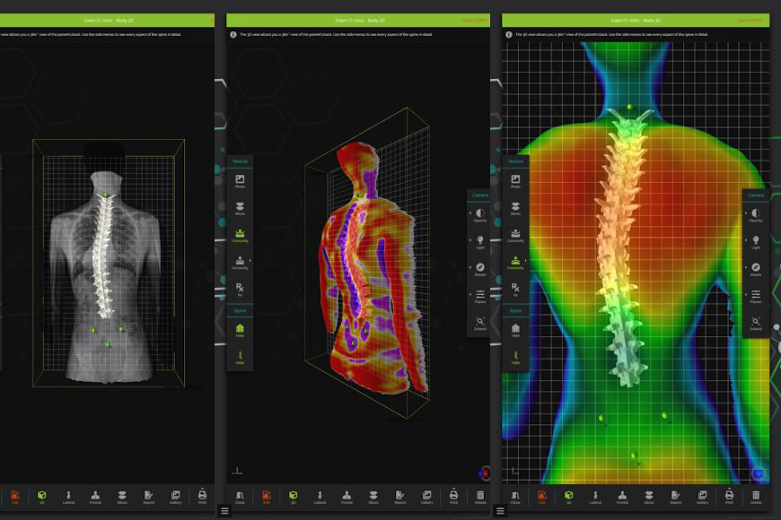 Skanowanie 3D kręgosłupa – efekty badania
