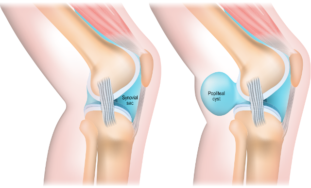 Torbiel Bakera – powstawanie
